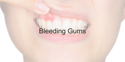 Bleeding Gums - Video